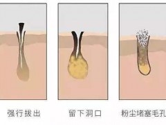 密密麻麻的黑头太影响颜值了！如何去黑头才更有效呢？