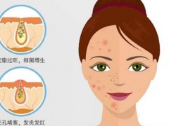 闭口是什么？该怎样才能有效的缓解呢？