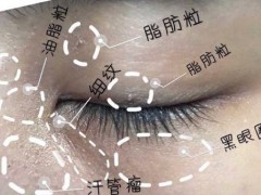 眼周长脂肪粒怎么办？脂肪粒怎么去除？
