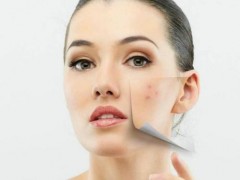 脸颊总长痘痘咋回事？该如何消除呢？