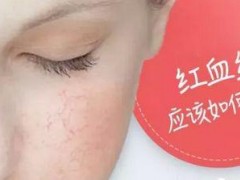脸上长红血丝了怎么办？