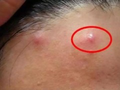 脸上冒红痘痘怎么消红？