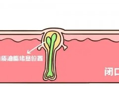 三伏天闭口、黑头、痘痘怎么拯救？