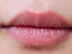 秋季嘴唇干燥起皮怎么办？如何进行护理？