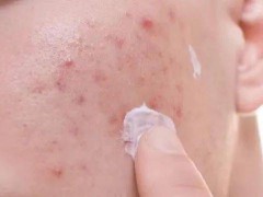 痘痘留下的红印怎么消除？