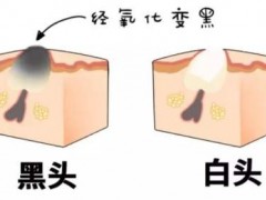 日常去黑头的小技巧！