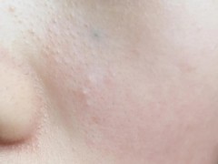 闭口老不好？你做好这3点了吗？