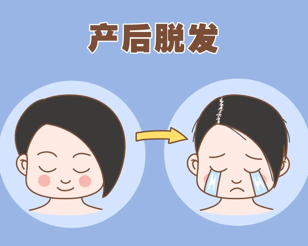 产后脱发怎么办？