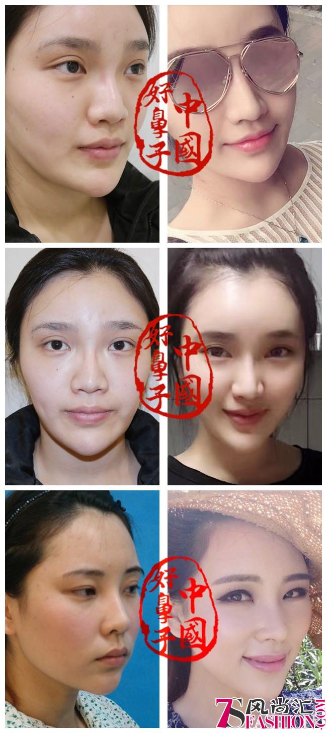 黄寺美容整形外科综合隆鼻打造完美鼻形，你也能拥有神仙侧颜