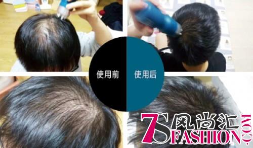 生物科研之作ZAOL滋尔沃，让头发再度开始茂盛“生长”