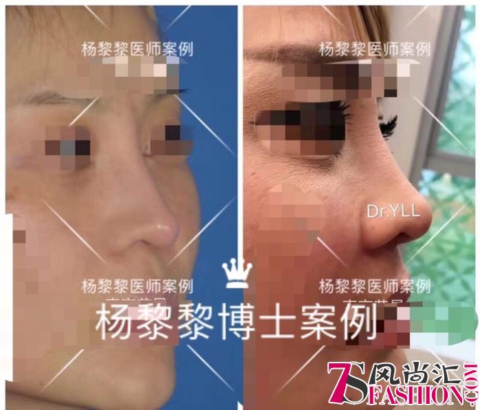杨黎黎博士：中国非手术隆鼻的“美学”探索者