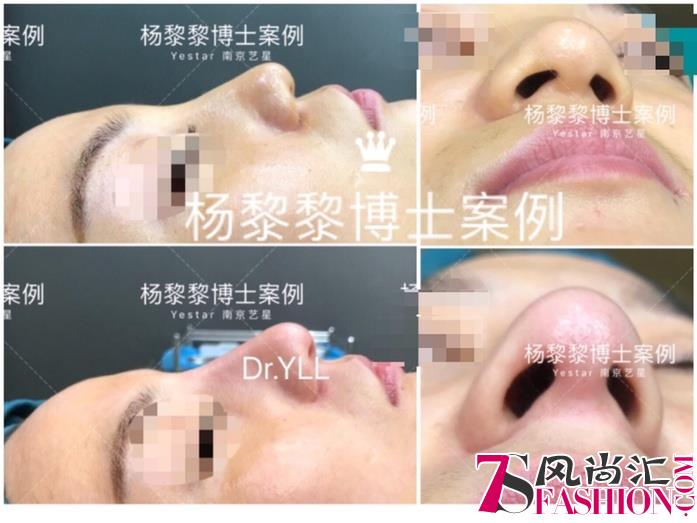 杨黎黎博士：中国非手术隆鼻的“美学”探索者