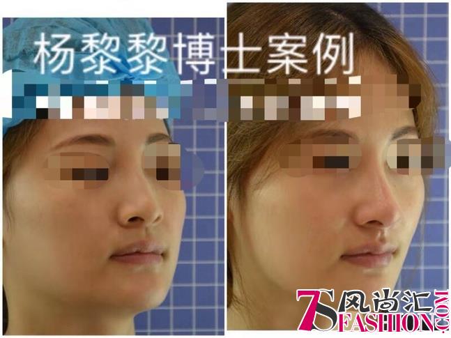 杨黎黎博士：中国非手术隆鼻的“美学”探索者