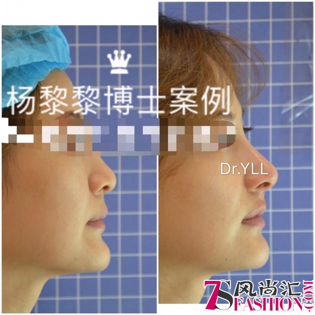 杨黎黎博士：中国非手术隆鼻的“美学”探索者