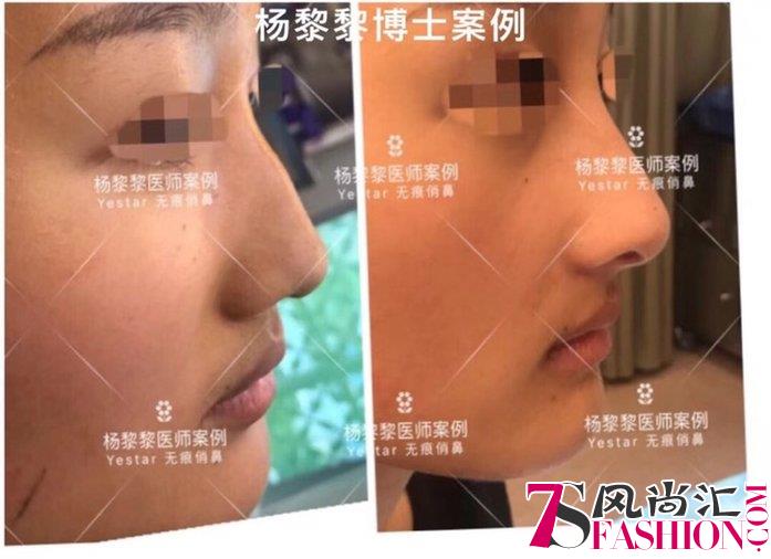 杨黎黎博士：中国非手术隆鼻的“美学”探索者