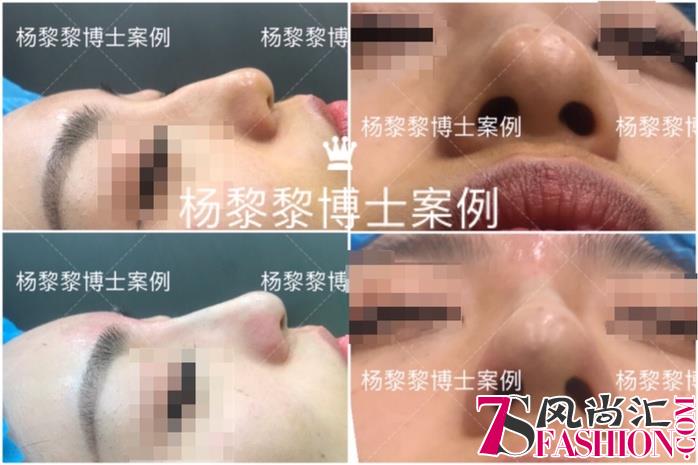 杨黎黎博士：中国非手术隆鼻的“美学”探索者