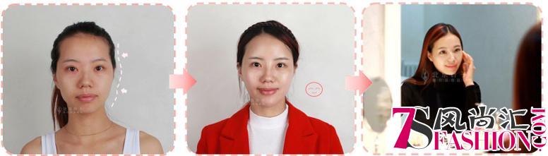 北京叶子杨峰携手韩国脂肪大师姜景进教授 全面升级面部填充技术