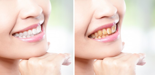 教你让牙齿变白的小妙招 掌握这些方法就能拥有一口好牙