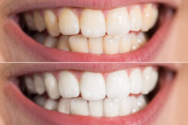 黄牙美白的方法 正确的处理口腔问题