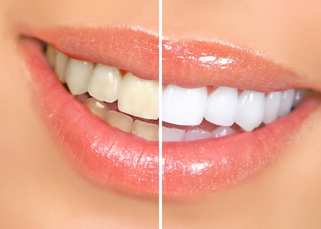 美白牙齿最有效的方法，告白大黄牙，试试这6招