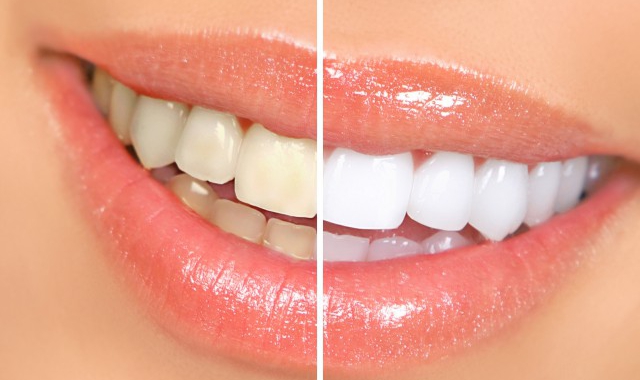 牙齿黄怎么办 教你几招改善牙黄问题困扰